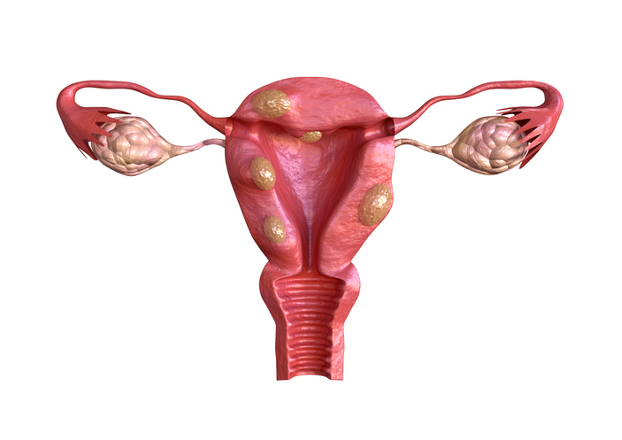 uterine fibroid are benign solid tumors formed by muscle tissue. Its size can vary greatly and some cause large abdomen increase. 3D rendering